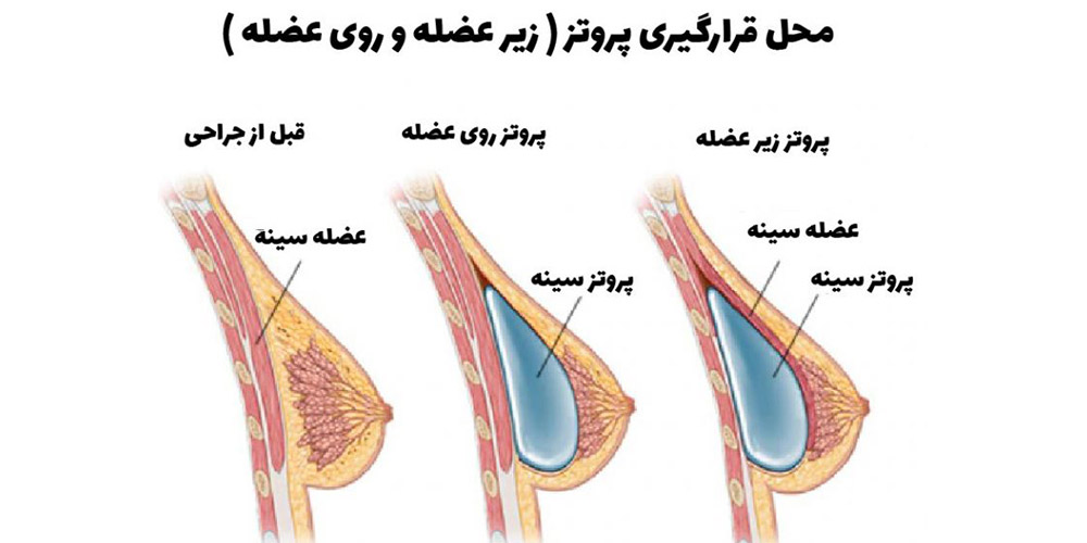 جراح پروتز سینه | پروتز سینه زیر عضله