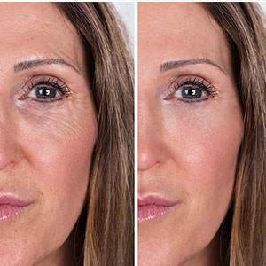 جالپرو برای زیر چشم