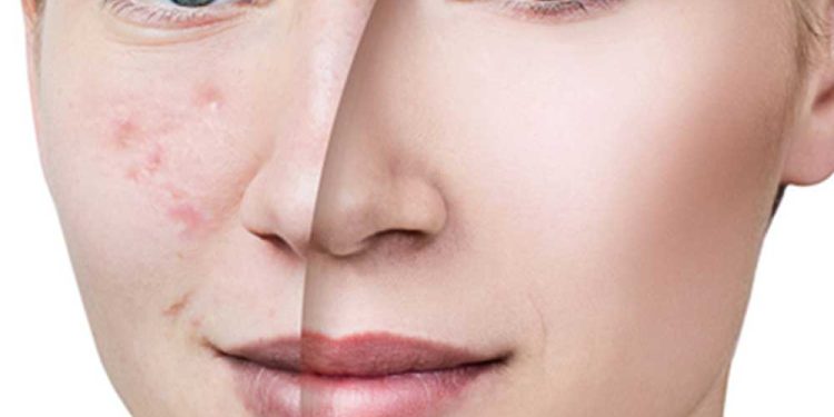 تاثیر مزوژل بر پوست