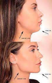 زاویه سازی صورت با تزریق ژل