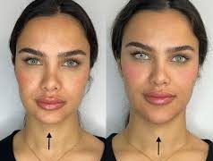 زاویه سازی صورت با تزریق ژل