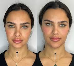 زاویه سازی صورت با تزریق ژل