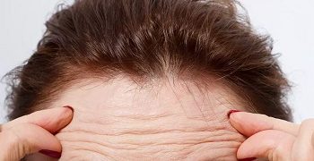 بهترین روش رفع چین و چروک پیشانی