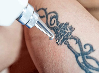 پاک کردن تاتو و خالکوبی