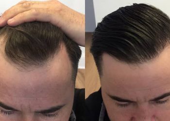 بهترین روش‌ کاشت مو