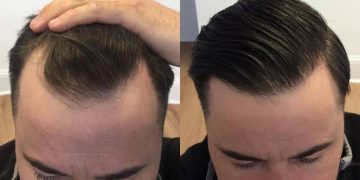 بهترین روش‌ کاشت مو