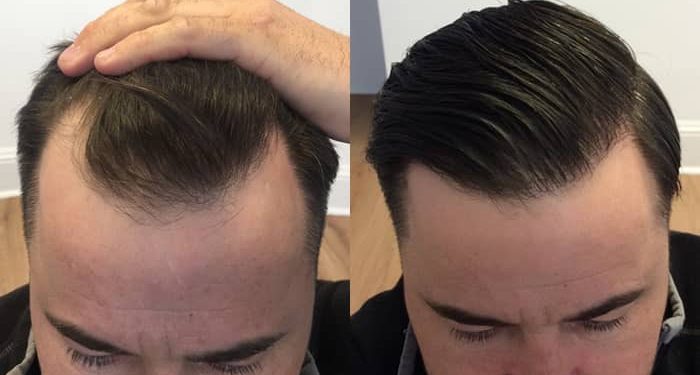 بهترین روش‌ کاشت مو