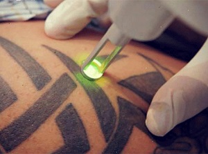 پاک کردن تاتو و خالکوبی