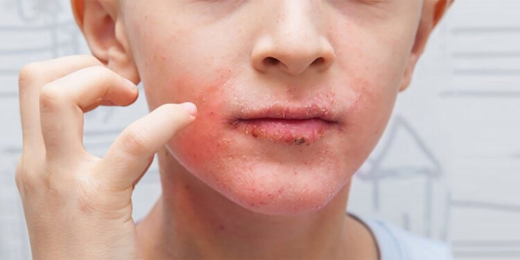 التهاب پوستی