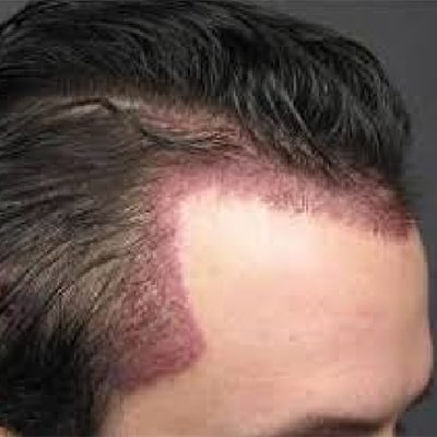 بهترین روش‌ کاشت مو