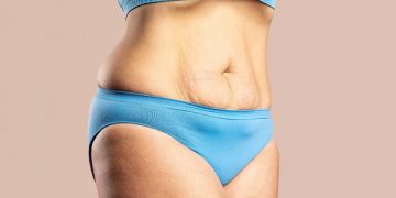 جلوگیری از شل شدن پوست در لاغری