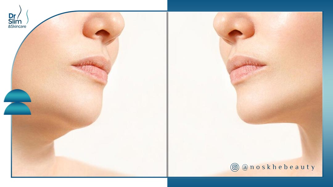 بهترین دستگاه برای از بین بردن غبغب