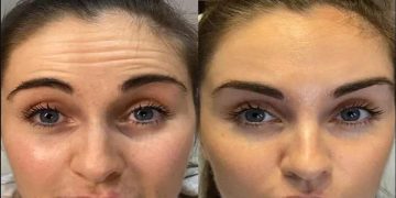 درمان‌های خانگی برای رفع چروک پیشانی و مقایسه تاثیر آن‌ها