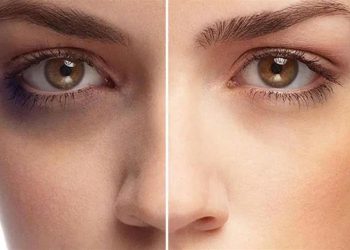 اگزوزوم تراپی راه حلی موثر برای رفع تیرگی دور چشم