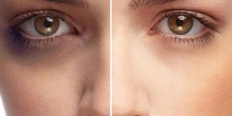 اگزوزوم تراپی راه حلی موثر برای رفع تیرگی دور چشم