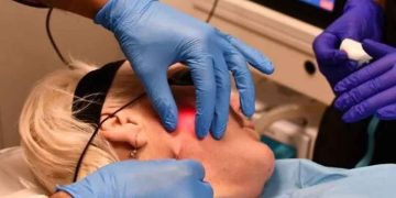 اندولیفت صورت چیست