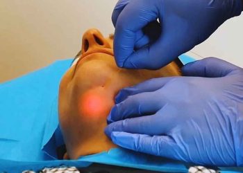 اندولیفت غبغب چیست