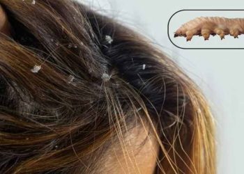 روغن نارگیل راهکار خانگی درمان دمودکس پوست سر