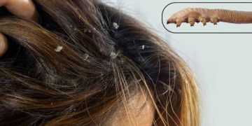 روغن نارگیل راهکار خانگی درمان دمودکس پوست سر