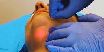 اندولیفت غبغب چیست