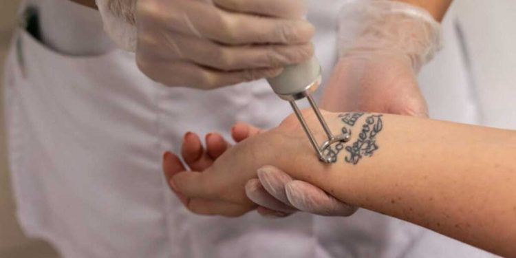 آیا جای لیزر تاتو میماند