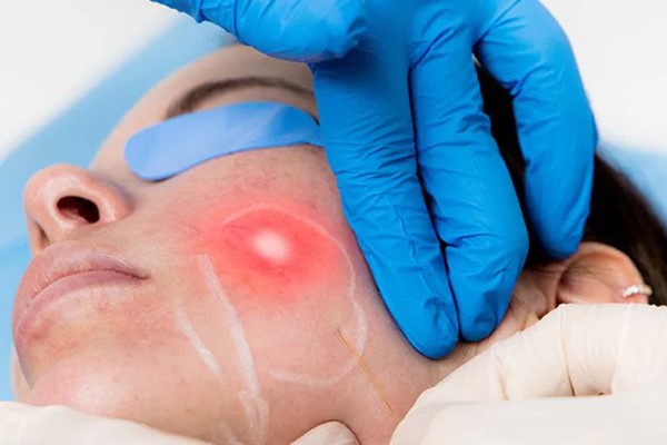 اندولیفت صورت چیست