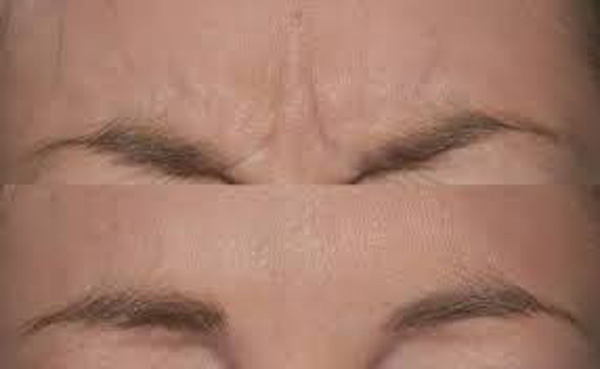 بوتاکس خانگی خط اخم با روغن نارگیل