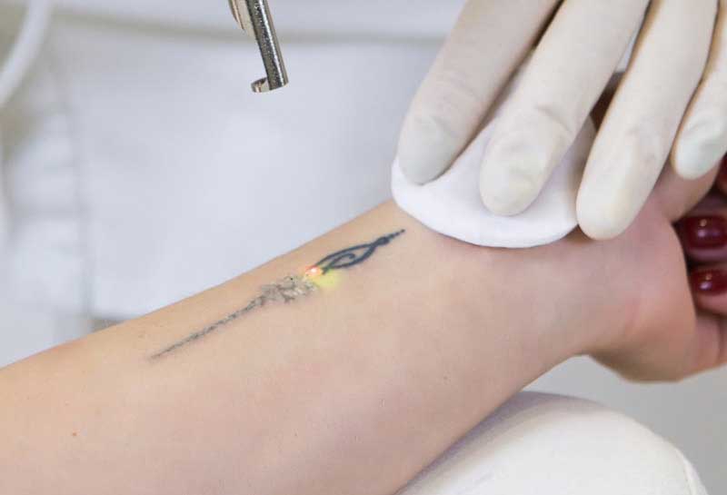 آیا جای لیزر تاتو میماند