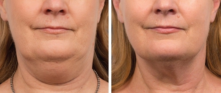 اندولیفت غبغب چیست