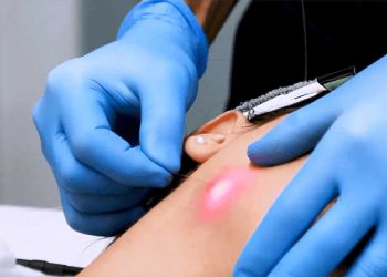 اثرات اندولیفت بر کلاژن‌سازی