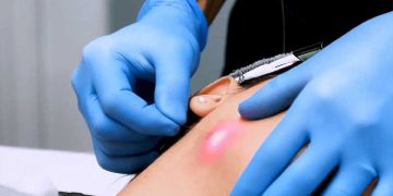 اثرات اندولیفت بر کلاژن‌سازی