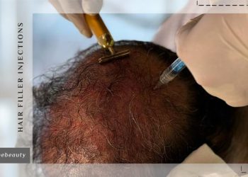 تزریق هیرفیلر مو