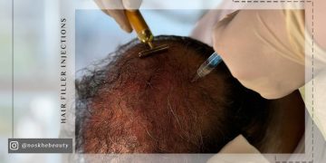 تزریق هیرفیلر مو