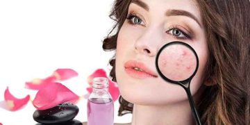 از بین بردن جوش صورت با گلاب