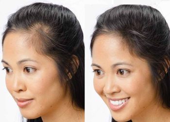 درمان ریزش سکه ای مو