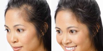 درمان ریزش سکه ای مو