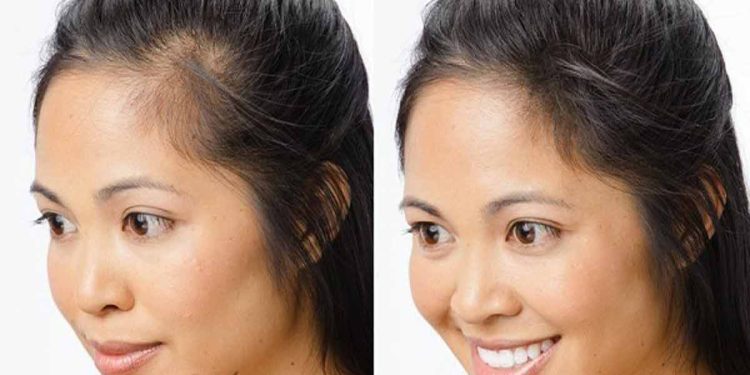 درمان ریزش سکه ای مو