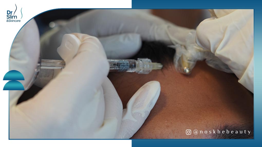 تزریق هیرفیلر مو