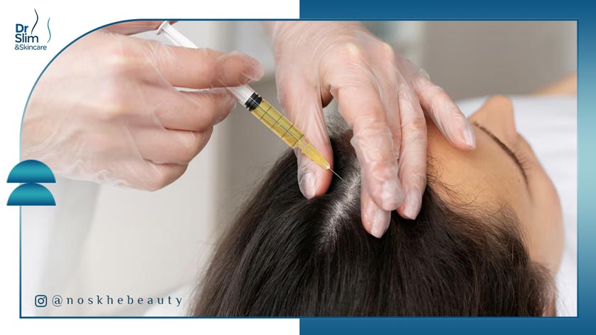 تزریق هیرفیلر مو