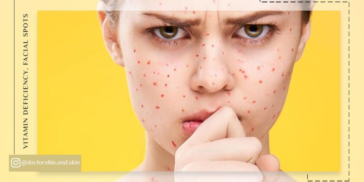 کمبود کدام ویتامین ‌ها باعث لک صورت می ‌شود