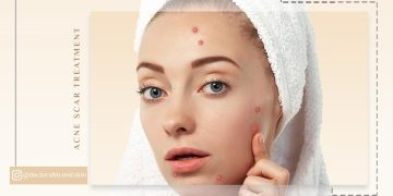 درمان اسکار جوش