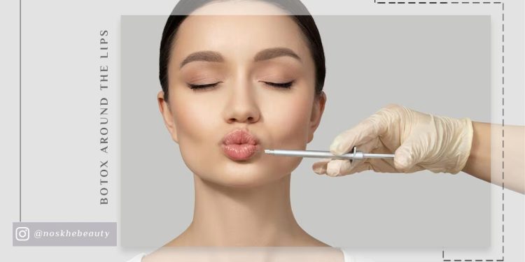 بوتاکس دور لب