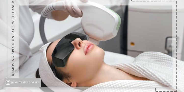 از بین بردن لکه های قهوه ای صورت با لیزر