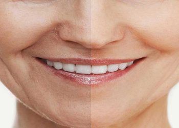 از بین بردن چروک دور لب در خانه