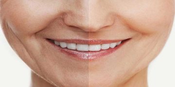 از بین بردن چروک دور لب در خانه