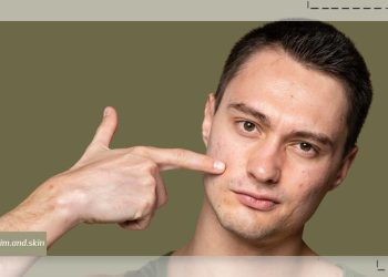 از بین بردن لکه‌ های قهوه ‌ای جای جوش