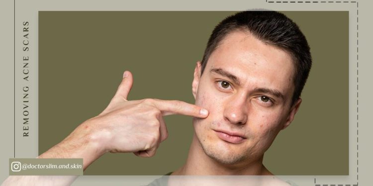 از بین بردن لکه‌ های قهوه ‌ای جای جوش