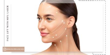 لیفت صورت با لیزر هایفو