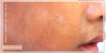 لک سفید روی پوست