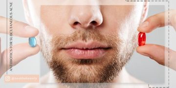 آنتی بیوتیک برای جوش زیر پوستی